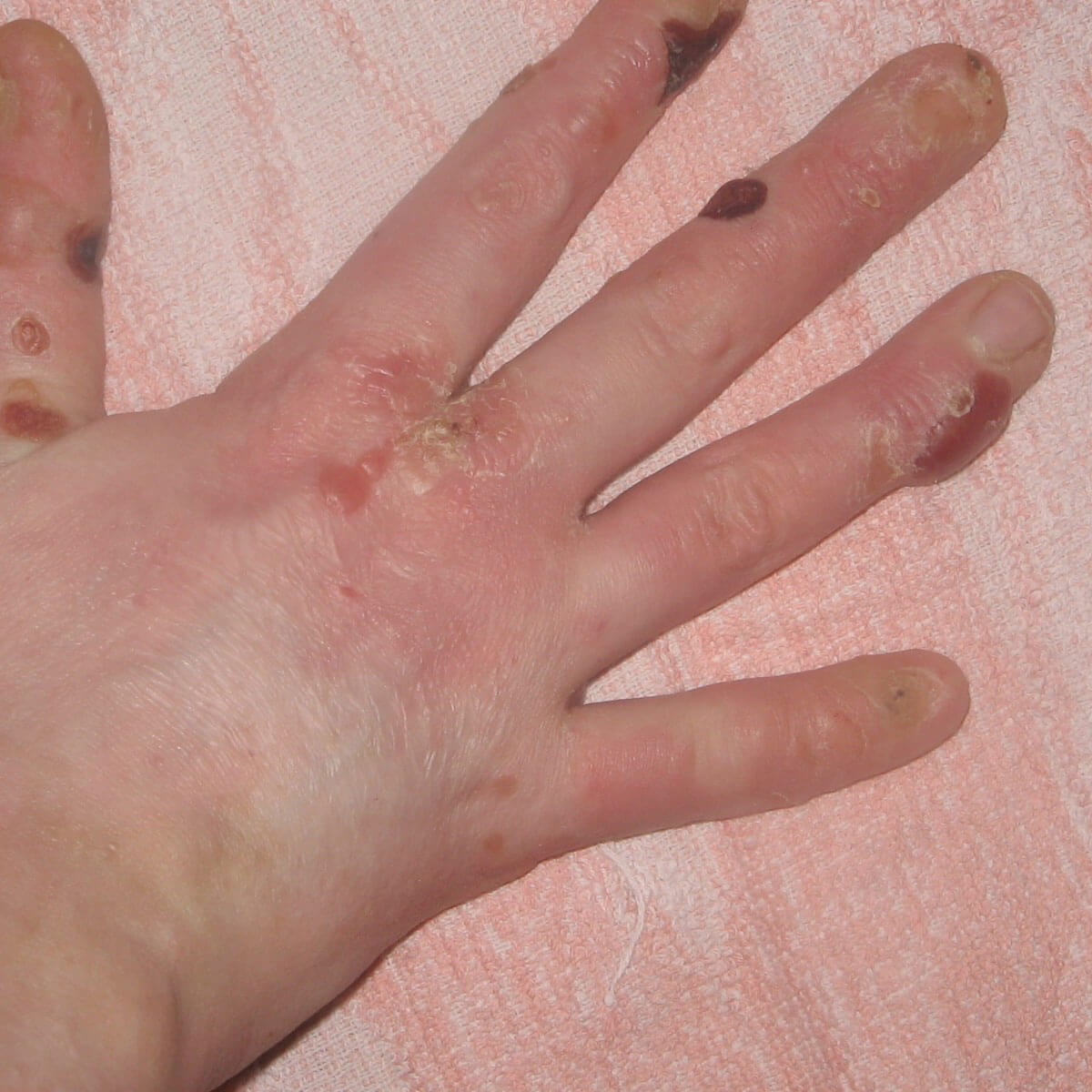 Blasen an den Finger