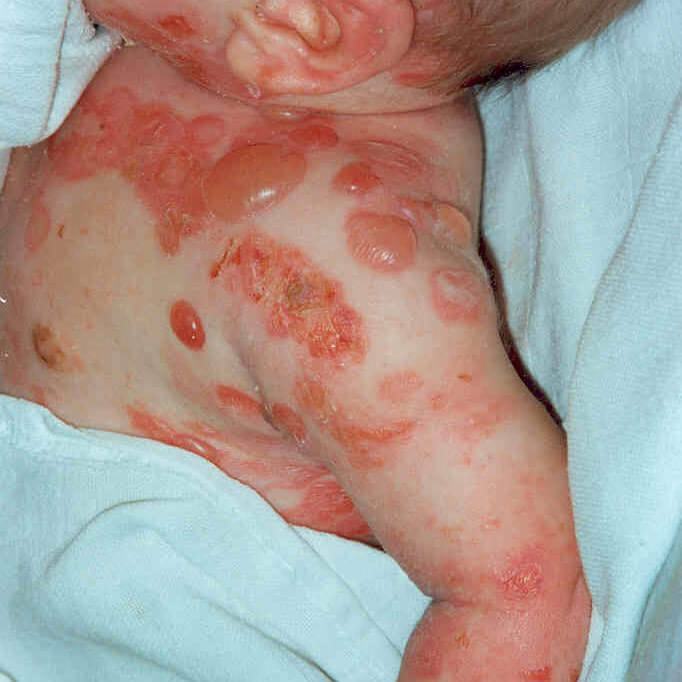 Zeichen von EB bei einem Neugebohrenen